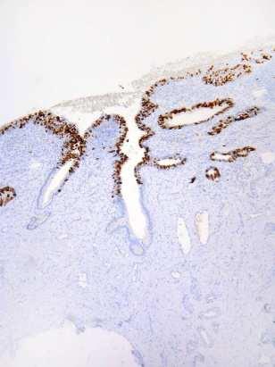 adenocarcinoma in situ neoplasia(cgin) High