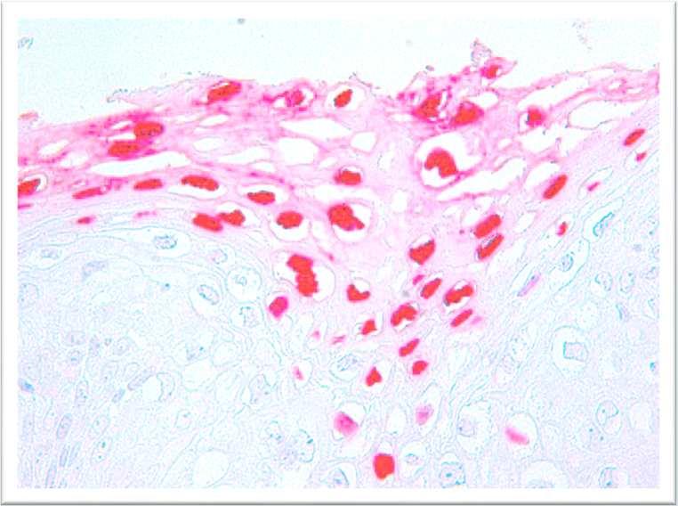 30 Biomarkerek használata p16 INK4a, L1-kapszid fehérje Molekuláris jelzők Immunhisztokémia L1-kapszid fehérje a vírus replikációja zajlik. Szövettani mintában vizsgálható.