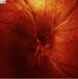 Disease (SVD) Bevezető tünetek fejfájás + látásvesztés kétszemes érintettség látásvesztés -