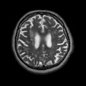 Az Ocularis stroke - indirekt intrakraniális MR jelek az ún.