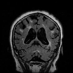 infarctusok (<1,0 cm ) a mély fehérállományi penetráló artériák infarctusa ( watershed zone infarct disease ) hypertónia, atherosclerosis kardiogén mikroembólizáció