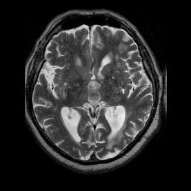 MR: 54,6% - (514 beteg adatai) coronalis FLAIR Torvik A, Skullerud K. Watershed infarcts in the brain caused by microemboli. Clin Neuropathology (1982; 1/3): 99-105.