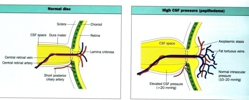 papilloedemával és o az Intracerebrális Vénás