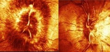 Sinusitis sph. S.Petrosus- S.Sigmoideus-Jugular v.