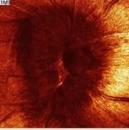 LÁTÓTÉR defektusa SAGITTAL SUPERIOR SINUS thr.