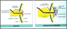 Intracerebrális thrombózist okozó szisztémás és neurológiai megbetegedések Walsh-Hoyt: Clinical Neuro-Ophthalmology, Venous Occlusive Disease. 6th ed.p.2445 Szisztémás és neurológiai megbetegedések Congenitalis thrombophilia Factor V.