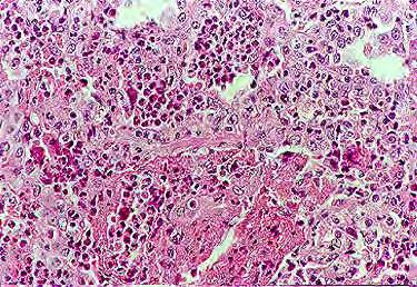 Eosinophil granulomatosus polyangiitis (EGPA, Churg-Strauss) kritériumai (ACR 1990) 4/7 1. Asthma 2. Eosinophilia (>10%) 3. Szezonális allergia 4.