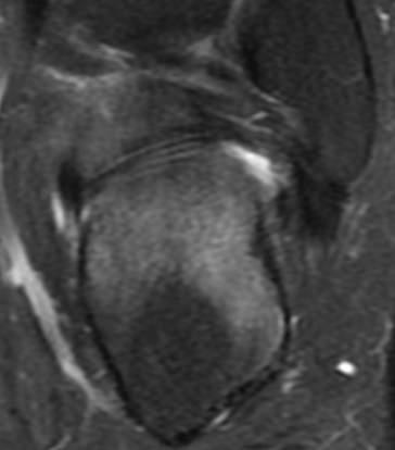 Calcaneo- navicularis (53%) Talo- calcanealis