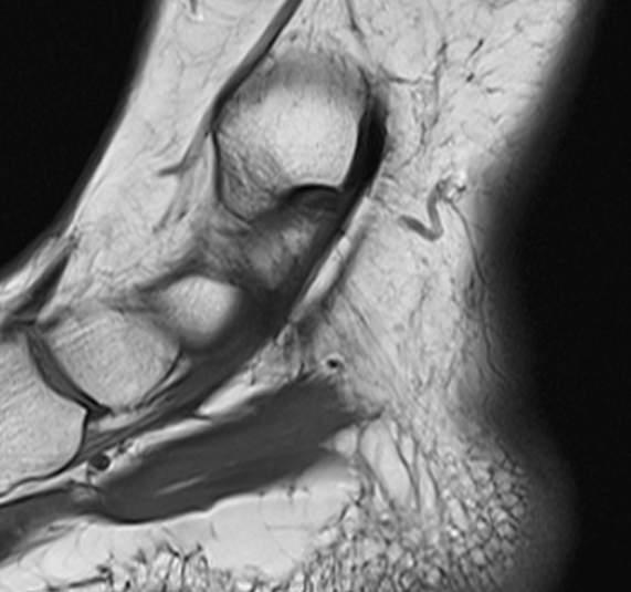 TIBIALIS POSTERIOR ÍN 1. Retromalleolaris TPT: Tendinopathia, tenosynovi s, re naculopathia - luxa o 2.