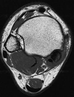 TENDINOPATHIA I.