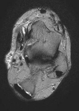 TENDINOPATHIA II.