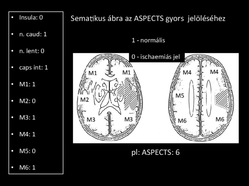 3.2. Multifázisos CTA ASPECT szerint A multifázisos (háromfázisos) CTA 18 magában foglal egy hagyományos CTA-t az aortaívtől a koponyatetőig, melyet kis időkülönbséggel még két mérés követ a foramen