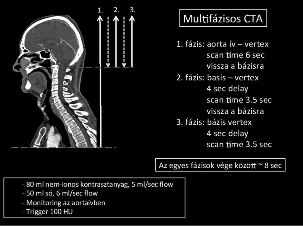 Technika A multifázisos CTA alapparaméterei: 80 ml nem ionos kontrasztanyag, 5 ml/sec flow 5. ábra.