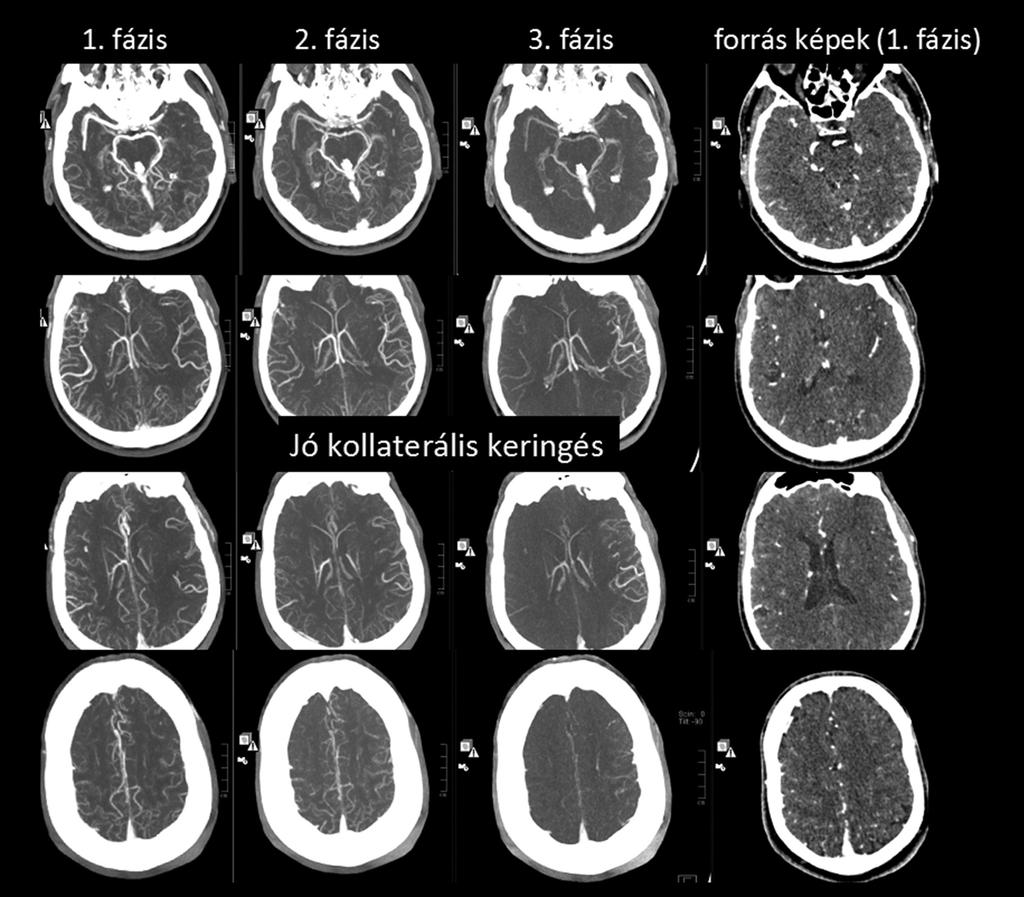 8. ábra. Jó kollaterális keringés. Bal oldali ACM occlusio. Már az 1. fázisban csaknem az ellenoldalhoz hasonló intenzitással és kiterjedéssel festődik a perifériás érhálózat, mely a 2.