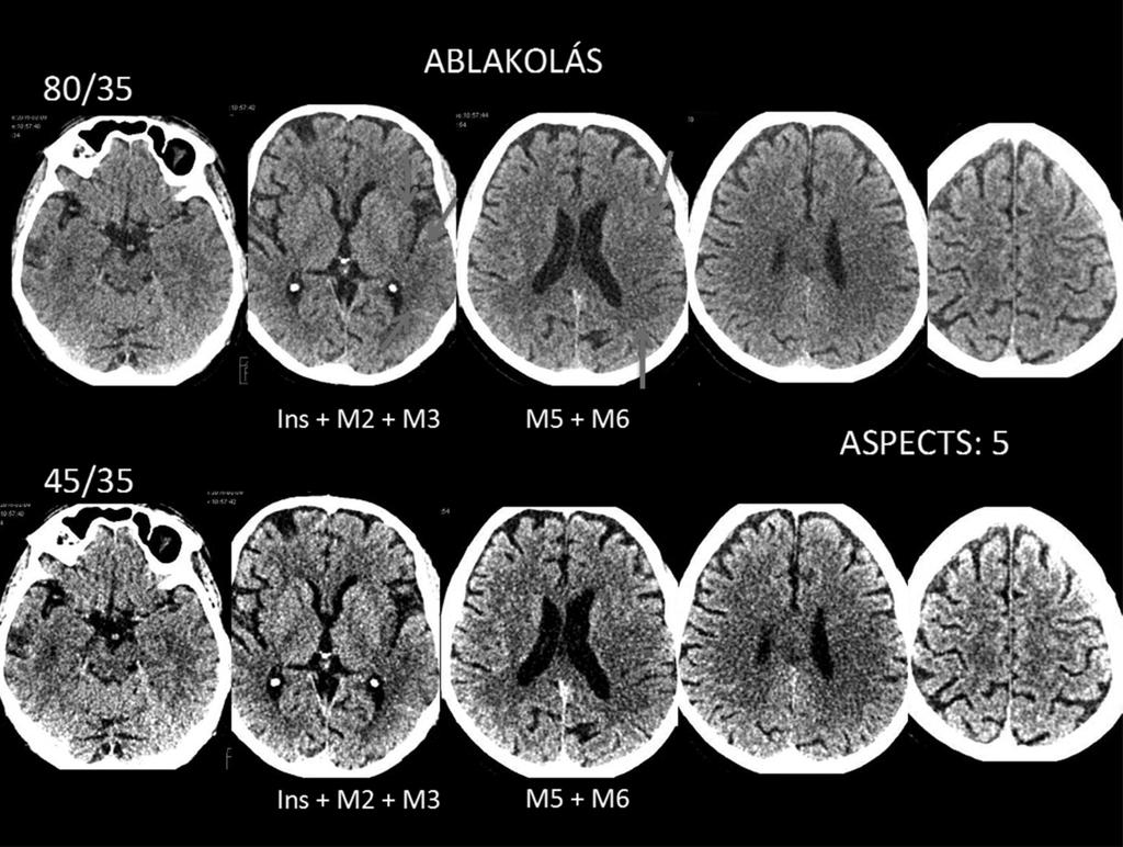 Cortica - lis an marad hét régió: insula, az alatta lévő cortex M2, ez előtti és mögötti területek pedig M1 és M3.