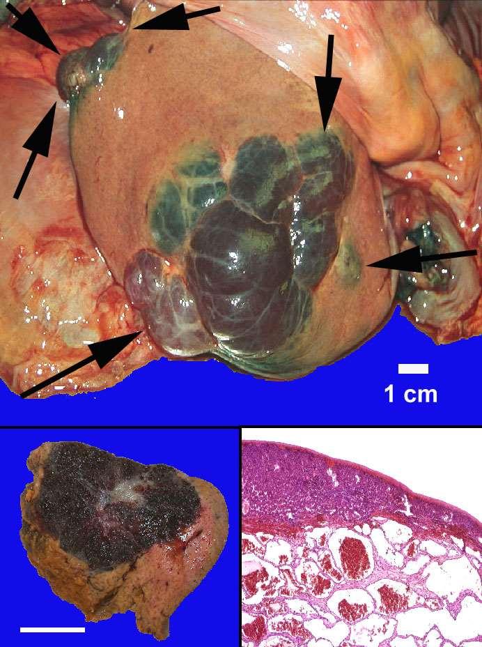 Haemangioma hepatis (giant).