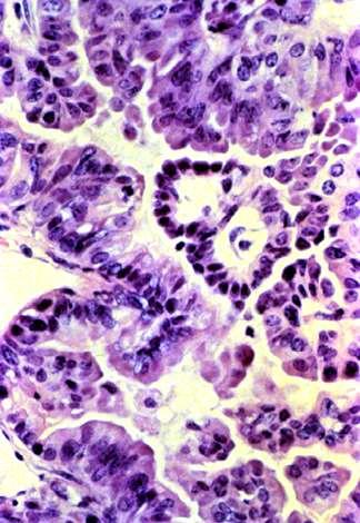 A tumorok osztályozása a sejtek jellegzetességei alapján (2) Mirigyhámból kiinduló: Benignus Adenoma, cystadenoma Malignus (carcinoma) Adenocc. Cystadeno cc. CC.
