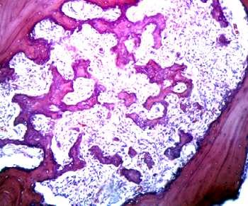 A tumorok osztályozása a sejtek jellegzetességei alapján (4) MESENCHYMALIS Benignus fibroma, lipoma