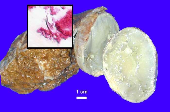 Ecchinococcus