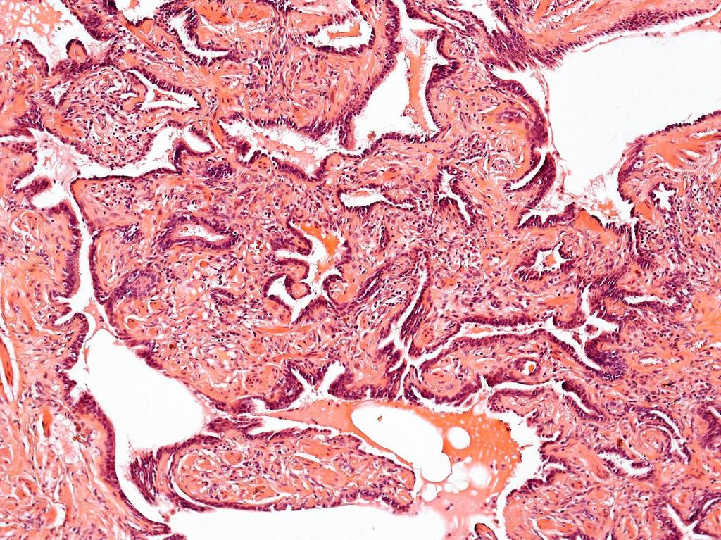 fibrózus alveoláris septumok