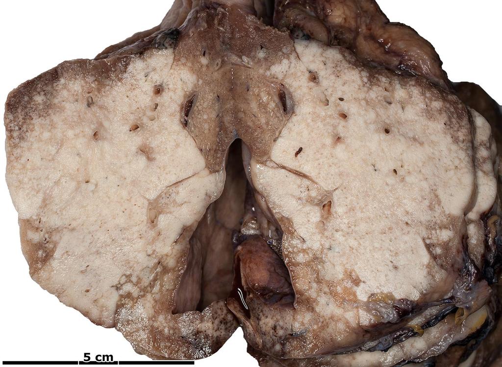 Adenocarcinoma.