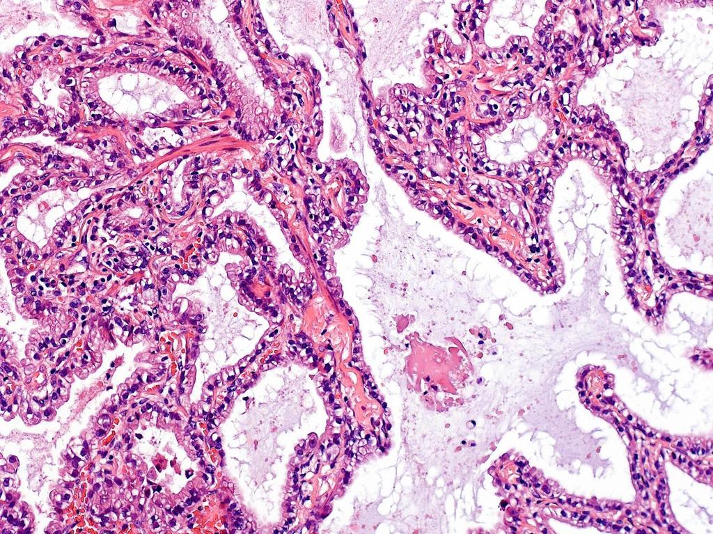 Adenocarcinoma: alveolusok