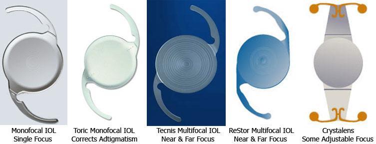 8. ábra Intraokuláris lencsék típusai [34] A műlencse nem képes törőerejét változtatni, így a páciens vagy közelre, vagy távolra lát élesen, attól függően, hogy műtét során milyen törőerejű lencse