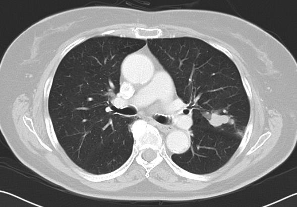 Diagnostic yield: perifériás léziók Perifériás léziók esetén a szenzitivitás leginkább a lézió nagyságától függ: 879 betegnél > 2 cm léziónál a szenzitivitás 0.