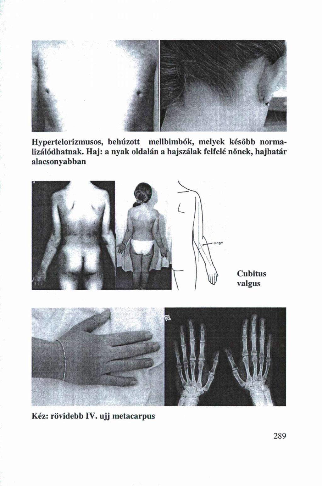 Hypertelrizmuss, behúztt mellbimbók, melyek később nrmalizálódhatnak.