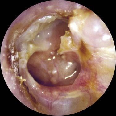 Otitis