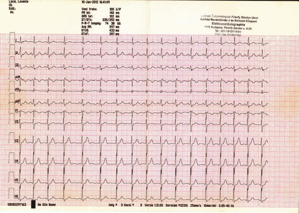 6.. Az EKG görbékről és azok feldolgozásáról 8 6.. ábra. Példa papír alapú 2 pontos EKG felvételre.