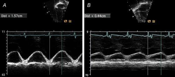 A jobb kamra systolés funkciójának mérése TAPSE: tricuspid valve