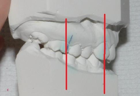 görbe: kifejezett Bal oldal: Angle II > 1 praemol.