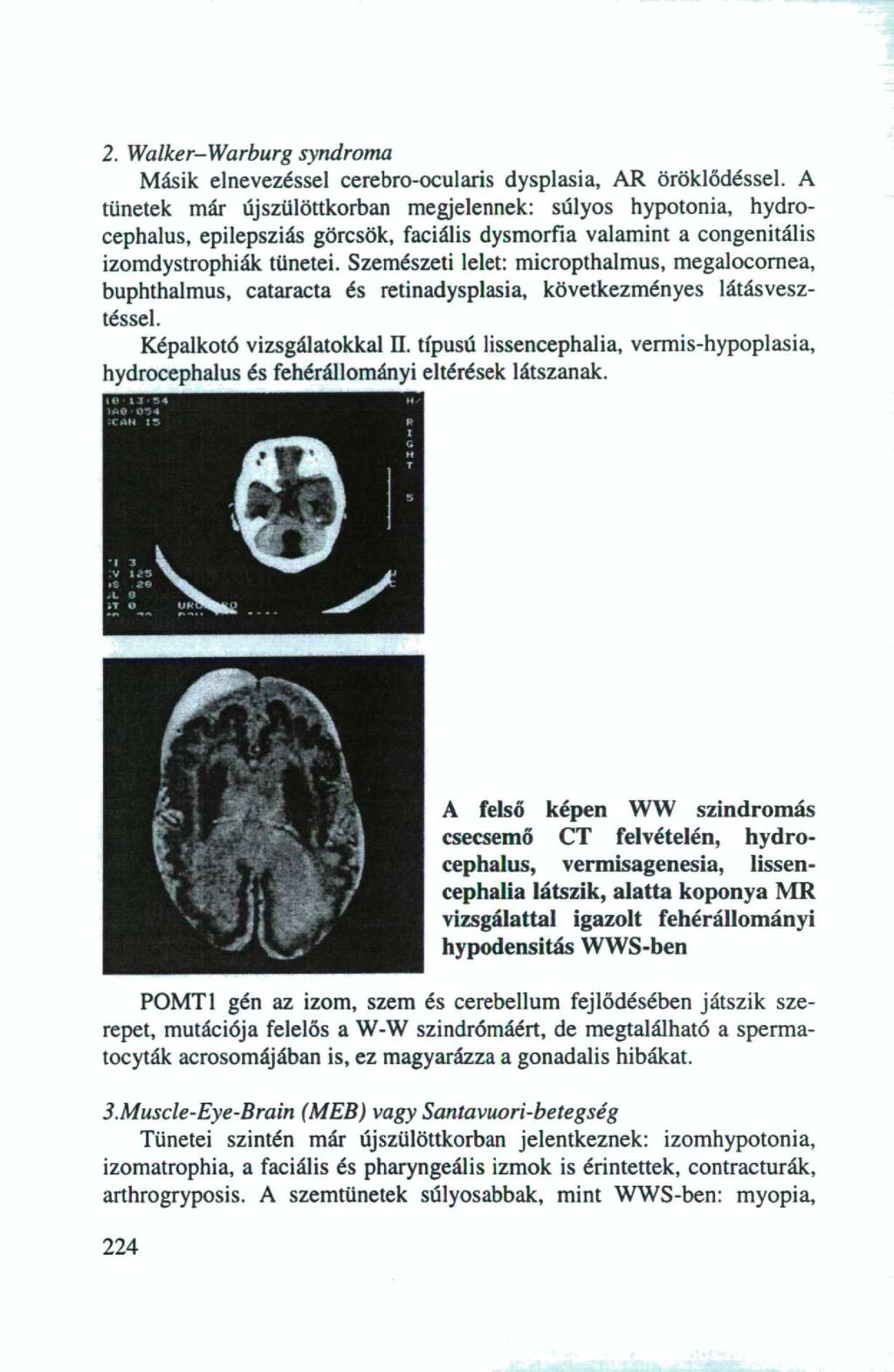 2. Walker-Warburg syndroma Másik elnevezéssel cerebro-ocularis dysplasia, AR öröklődéssel.