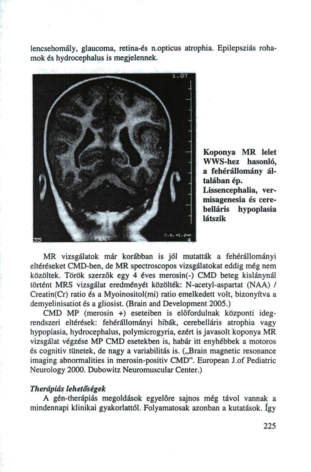 lencsehomály, glaucoma, retina-és n.opticus atrophia. Epilepsziás rohamok és hydrocephalus is megjelennek. Koponya MR lelet WWS-hez hasonló, a fehérállomány általában ép.