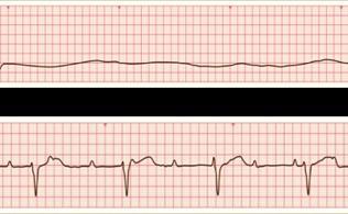 10 13. 6 pont Nevezze meg a képen látható EKG-eltéréseket!