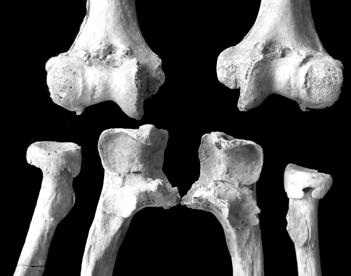 8: Bilateral osteoarthrosis at the elbow (grave No. 183).