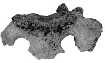 9: Significant osteophyte and hypervasularisation on the upper part of the sacrum and