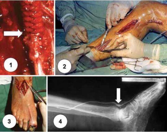 13 11. ábra. Kompozit bypass: 1. prothetico-saphaena anastomosis, 2. a lábszári szakasz, 3. a pedalis anastomosis, 4. angiogram a pedalis anastomosisról.