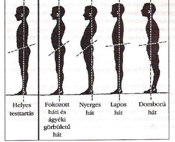 A helytelen tartásnak négy típusát különböztetjük meg (2. ábra): 1.