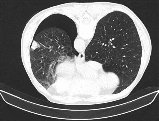 4. ábra 3,6 cm széles pneumothorax a bal tüdőben Mivel a beavatkozás során steril eszközöket használnak és a behatolás helyét alaposan dezinficiálják, így gyakorlatilag fertőzés nem fordulhat elő.