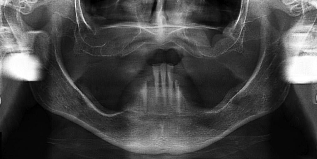 FOGORVOSI SZEMLE 109. évf. 1. sz. 2016. 23 27. Pécsi Tudományegyetem Klinikai Központ Fogászati és Szájsebészeti Klinika, Fogpótlástani Tanszék* Southgate Dental Ltd.