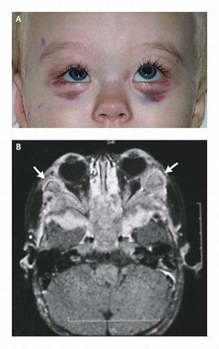 com/ Raccoon Eyes and Neuroblastoma