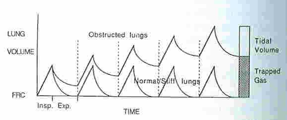 DHI progressiv tüdővolumen növekedés kilégzésvégi nyomás > atm