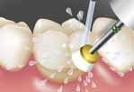 koronaszélek kezelésére A fognyaki felszínek kezelésére, professzionális fogtisztítás és
