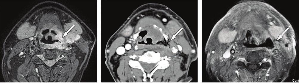 KIEGÉSZÍTŐ 3. ÁBRA. Bl ringo-piglottikus krinóm és posztirriáiós nkrózis. ) MRI, xiális CT1FS: primr státusz, tumorr nyíl mutt.
