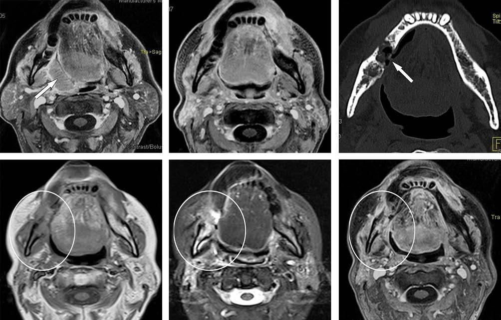 166 GŐDÉNY ÉS MTSAI 6. ÁBRA. Jo tonsill pltin krinóm irriáiój után mniulán kilkult osztorionkrózis. Axiális síkú rétgk. ) MRI, CT1FS: primr tumor (nyíl).