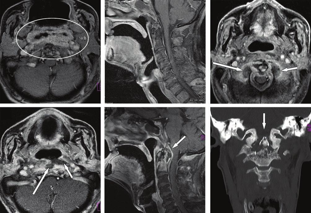 MRI ÉS CT FEJ-NYAKI DAGANATOK SUGÁRTERÁPIÁJÁNÁL 167 7. ÁBRA. Epirinxrák kmoriotrápiáj után kilkult sponilitisz és CII sigoly osztorionkrózis.