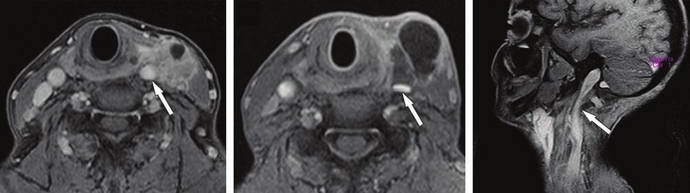 ) MRI, xiális CT1FS: RT után 9 hónppl lső nyksigolyák mntén minkét ollon kzőő nkrózis, gyullásos lágyrész (nyilk) láthtó. A töi kép z irriáió után 11 hónppl készült.