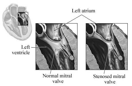 Billentyűbetegségek Mitralis stenosis: Gyakran előző reumás vagy infectív carditis következménye.